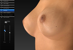 Breast Revision