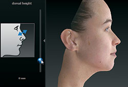 VECTRA® 3-D Imaging for Plastic Surgery in Rochester, NY