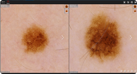 Lesion changes being monitored within DermaGraphix