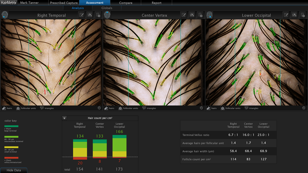 HAIRMETRIX ANALYSIS