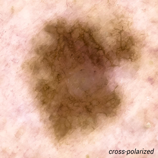 Cross Polarized Lesion