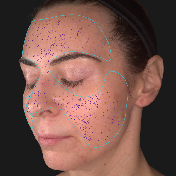 Advanced Skin Analysis - Pores