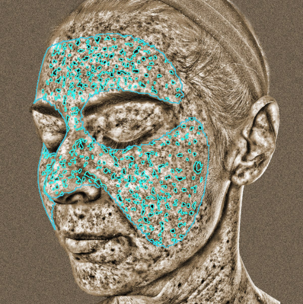 Advanced Skin Analysis - UV Spots