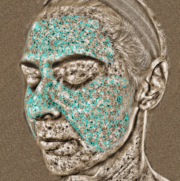 Advanced Skin Analysis - UV Spots