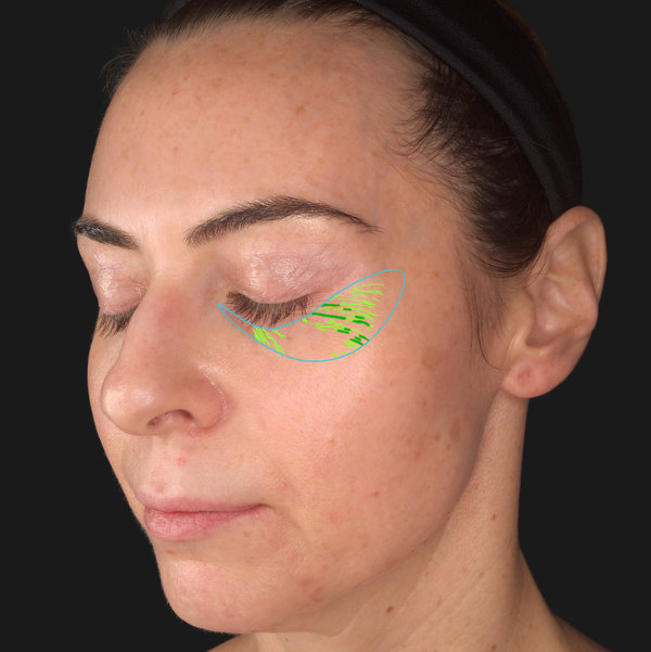 Advanced Skin Analysis - Wrinkles