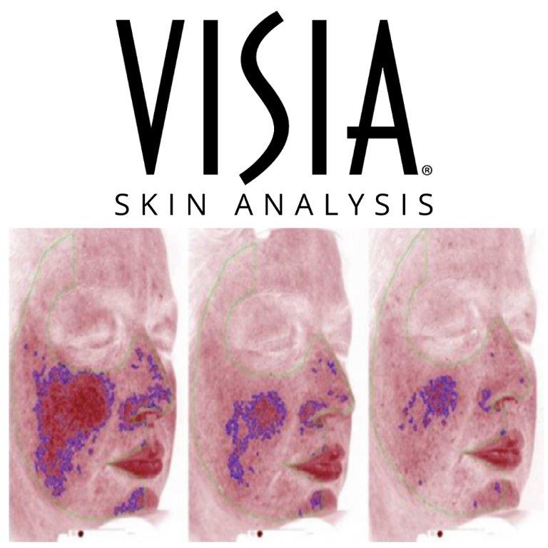 VISIA® Generation 7 helps investigators demonstrate efficacy of novel rosacea treatment
