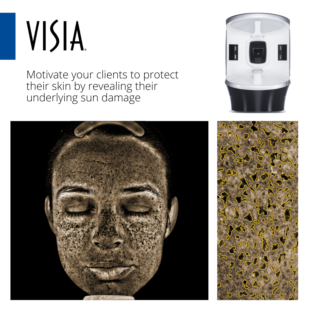 Sunscreen Protection Day: Motivate Your Clients to Be Proactive with VISIA®