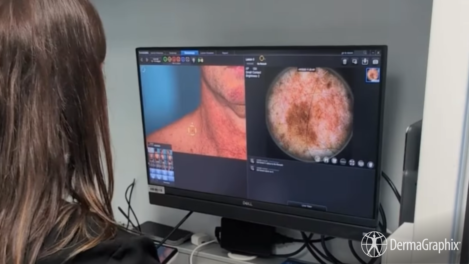 Mildura Base Public Hospital Foundation Brings Skin Screening Truck ...