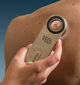 VEOS HD compact dermatoscope